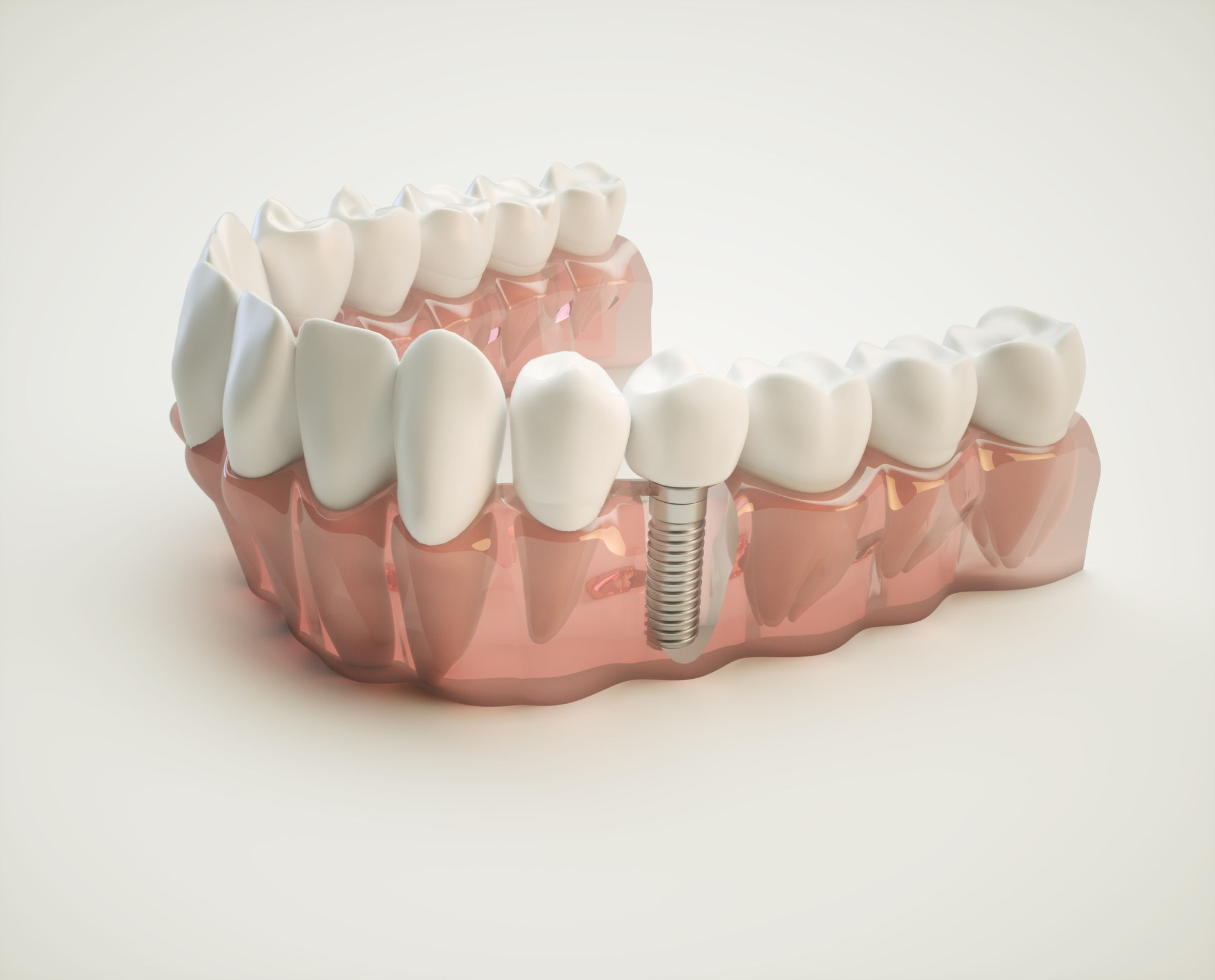 dental-implant-model-dental-implants-in-turlock-ca